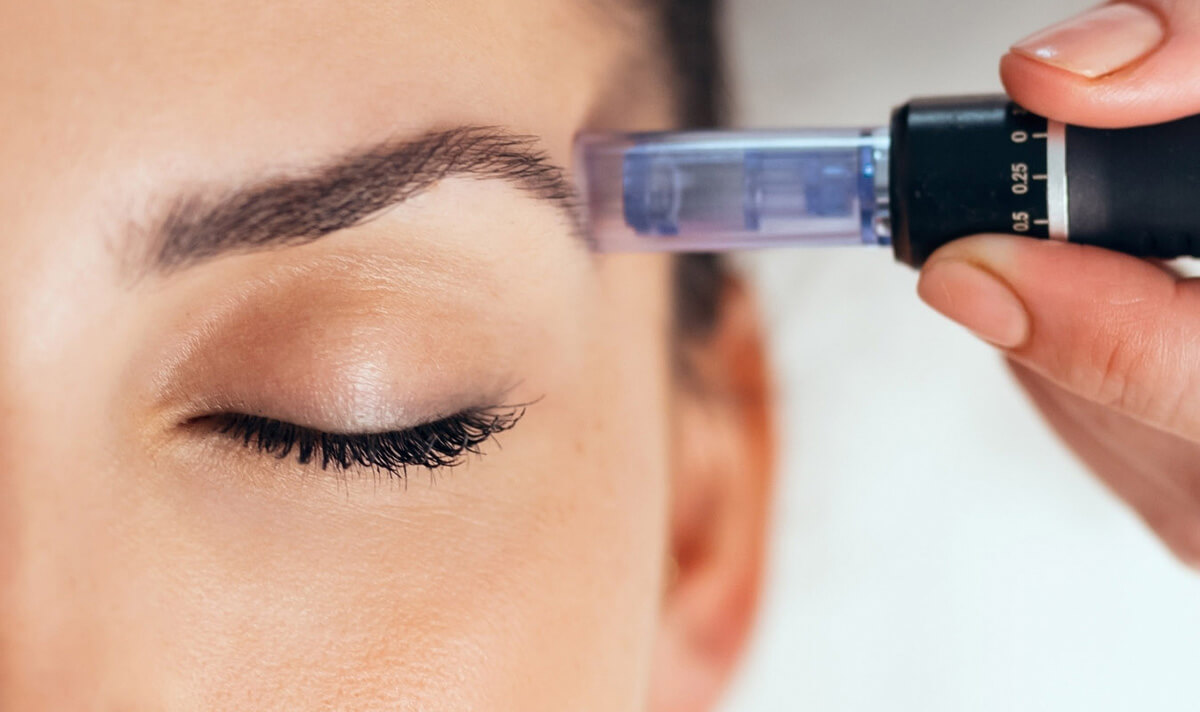 Exosomas Microneedling